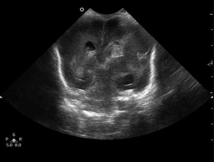 Germinal matrix hemorrhage - grade IV | Image | Radiopaedia.org