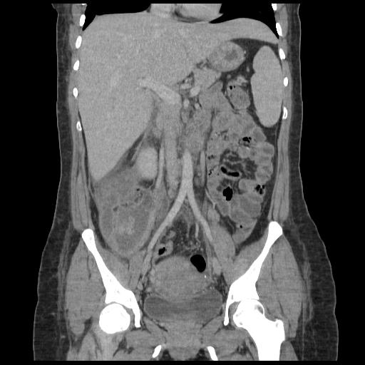 Uterine suture dehiscence and tubo-ovarian abscess | Image ...