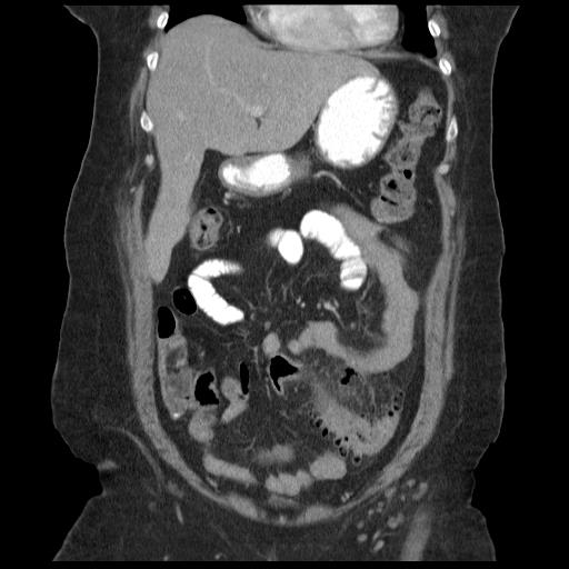 Colonic Diverticulitis Image Radiopaedia Org   F9fba2a9537c3674b3dc82b2780d34a090e9527f8f539ff6f85ed3874114d161 