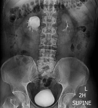 Horseshoe kidney and extrarenal pelvis | Image | Radiopaedia.org