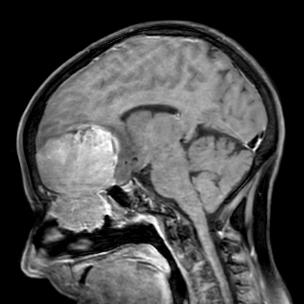 Sinonasal small cell carcinoma | Radiology Case | Radiopaedia.org