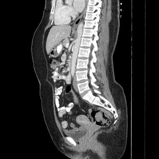 Nutcracker syndrome Image