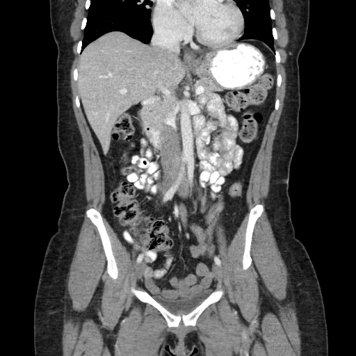 Nutcracker syndrome Image