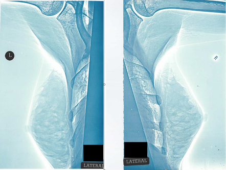 Obsolete imaging techniques | Radiology Reference Article | Radiopaedia.org