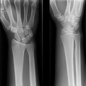 Chauffeur fracture | Radiology Reference Article | Radiopaedia.org