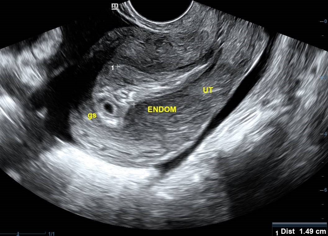 Ovarian Hyperstimulation Syndrome | Image | Radiopaedia.org