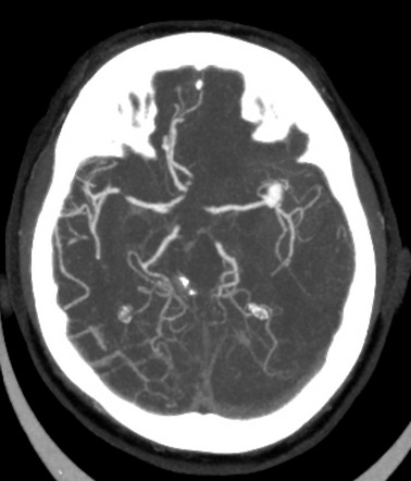 Playlist 'CNS INTRACRANIAL LESION 2' by atif latif