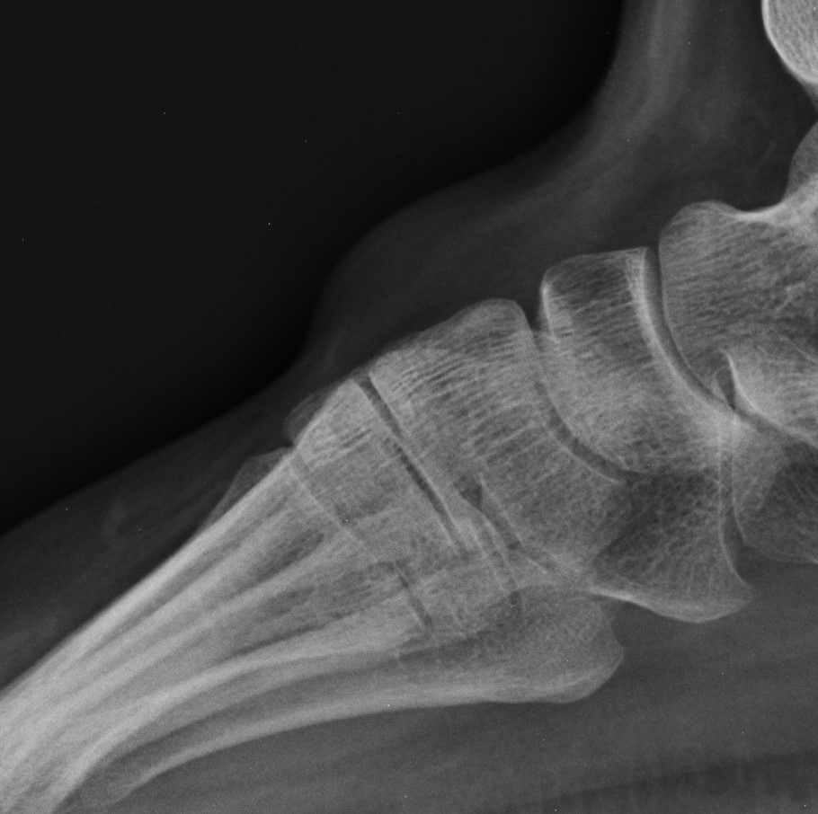 Intramuscular lipoma - foot | Image | Radiopaedia.org