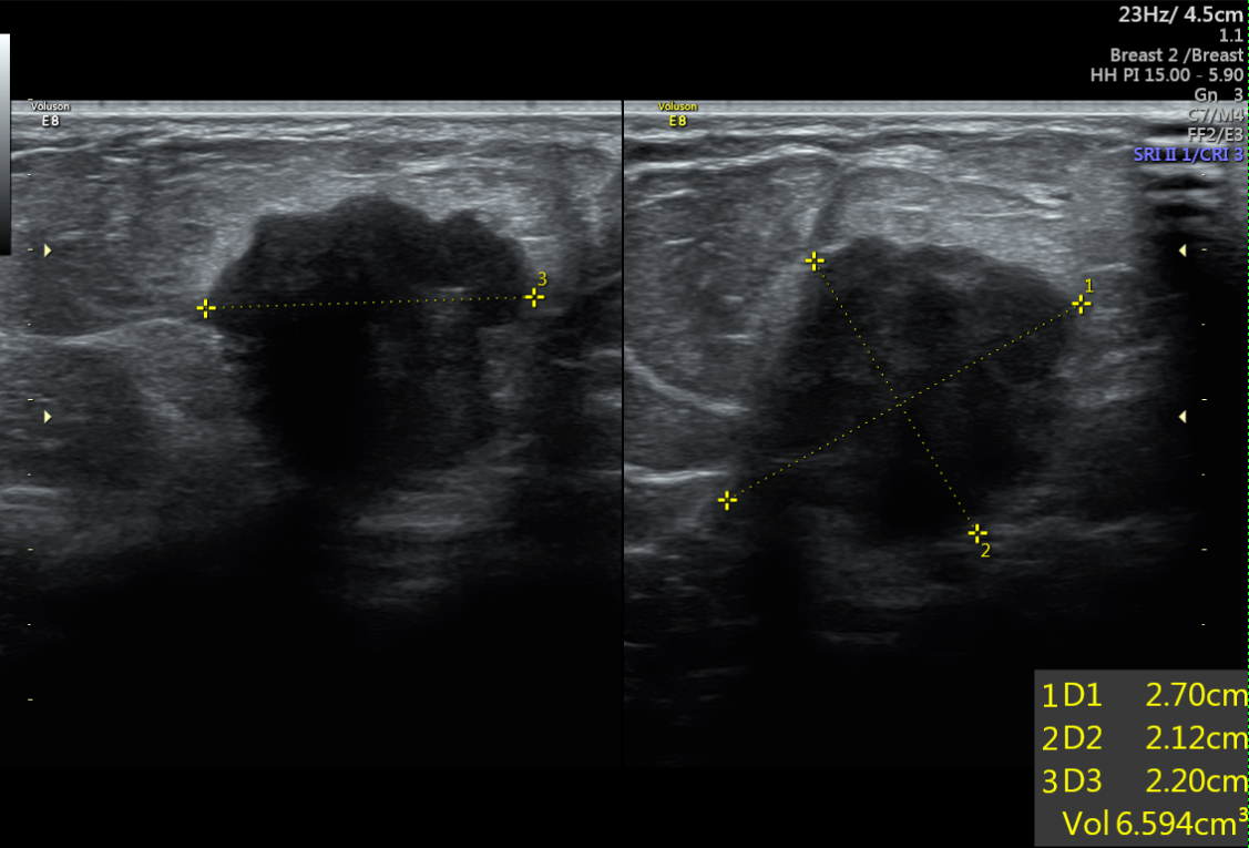 Breast mass (BI-RADS 4c) | Image | Radiopaedia.org