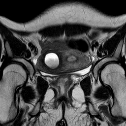 Unicornuate Uterus With Hematometra In Non-communicating Contralateral 