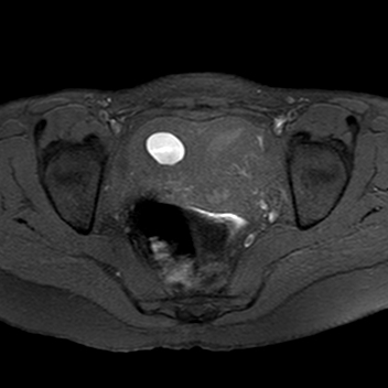 Unicornuate uterus with hematometra in non-communicating contralateral ...