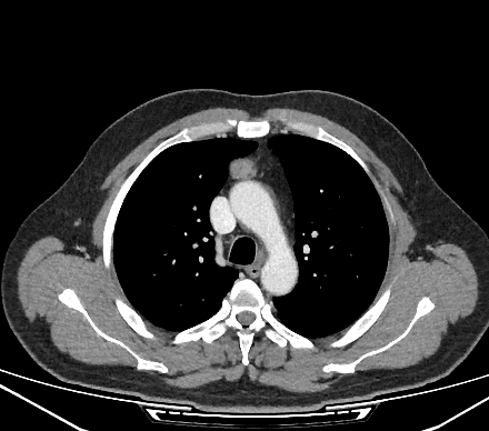 Thymic Carcinoma | Image | Radiopaedia.org