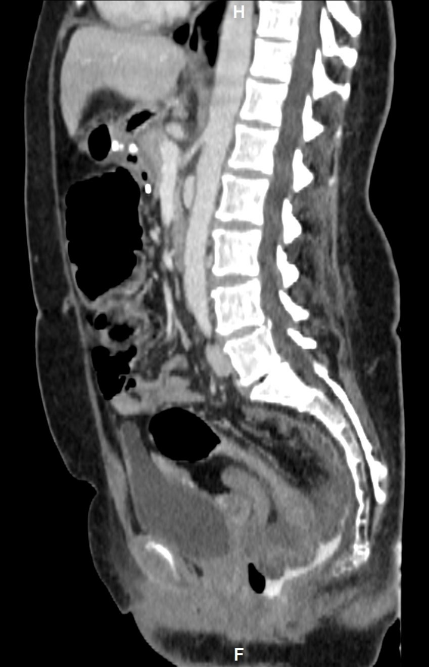 Colorectal Intussusception Image 3863