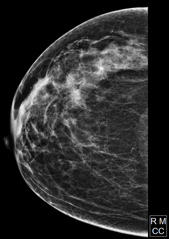 Large breast lipoma | Image | Radiopaedia.org