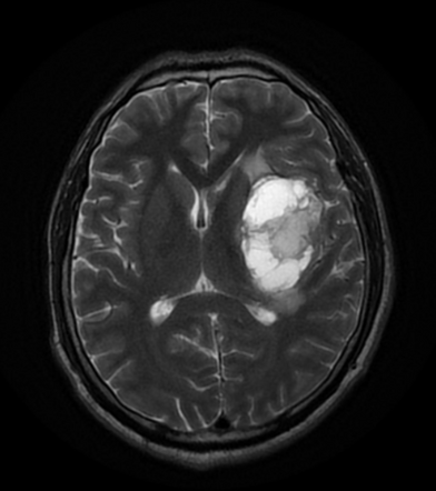 Glioblastoma NOS | Radiology Case | Radiopaedia.org