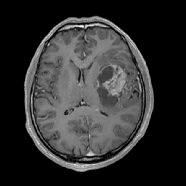 Glioblastoma NOS | Image | Radiopaedia.org