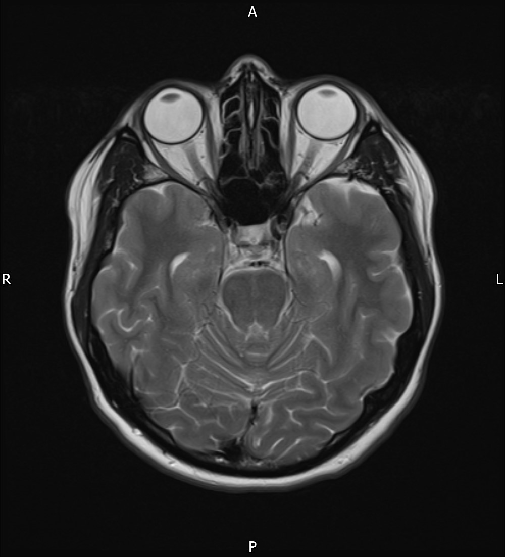 Pituitary Microadenoma Image