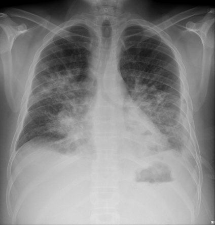 Kaposi's sarcoma | Radiology Case | Radiopaedia.org