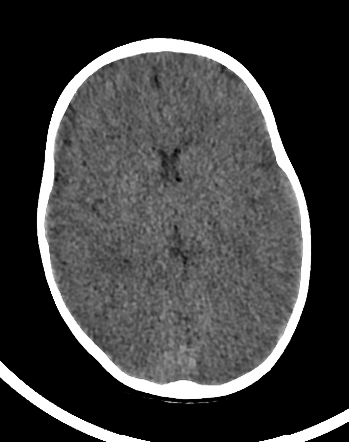 Global hypoxic ischemic encephalopathy | Radiology Case | Radiopaedia.org