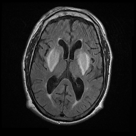 Uremic encephalopathy | Radiology Case | Radiopaedia.org