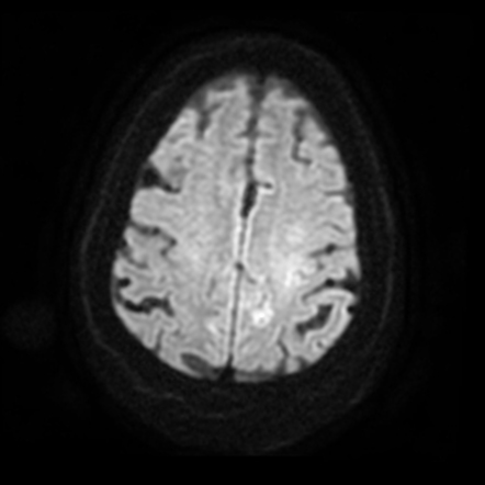 Uremic Encephalopathy | Image | Radiopaedia.org