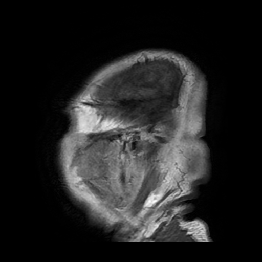 Uremic Encephalopathy | Image | Radiopaedia.org