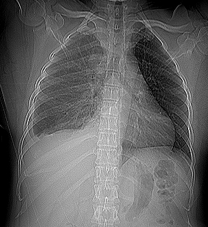 Lepidic-predominant adenocarcinoma of the lung | Image | Radiopaedia.org