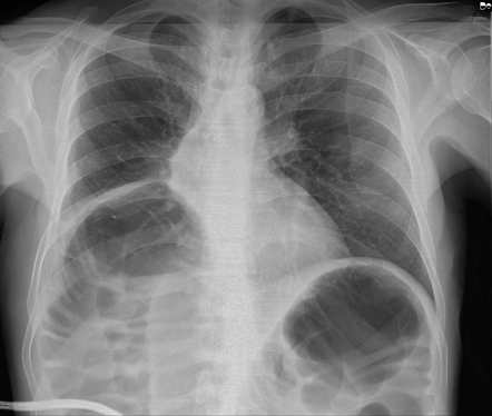 Chilaiditi sign | Radiology Case | Radiopaedia.org