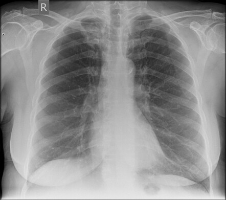 Apical lung cancer | Radiology Case | Radiopaedia.org