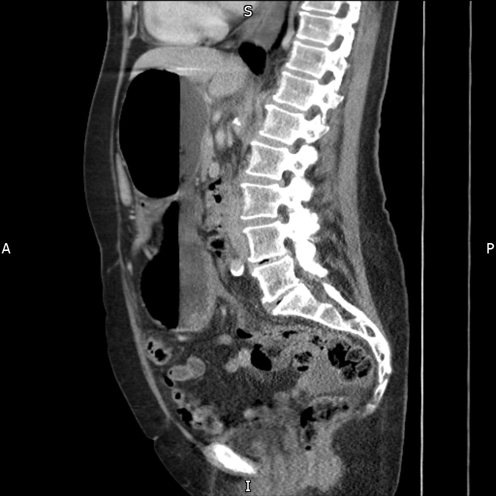 Cecal Volvulus Image