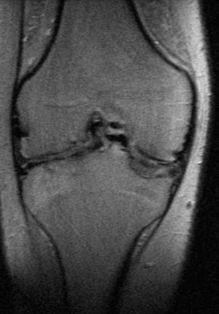 Haemophilic arthropathy | Radiology Case | Radiopaedia.org