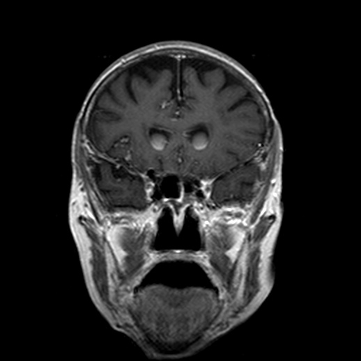 Ruptured Intracranial Dermoid Cyst Image