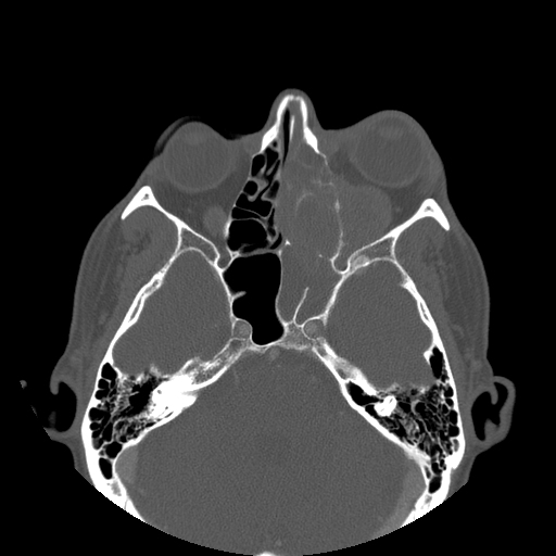 Poorly differentiated sinonasal squamous cell carcinoma | Image ...