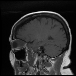 Poorly differentiated sinonasal squamous cell carcinoma | Image ...