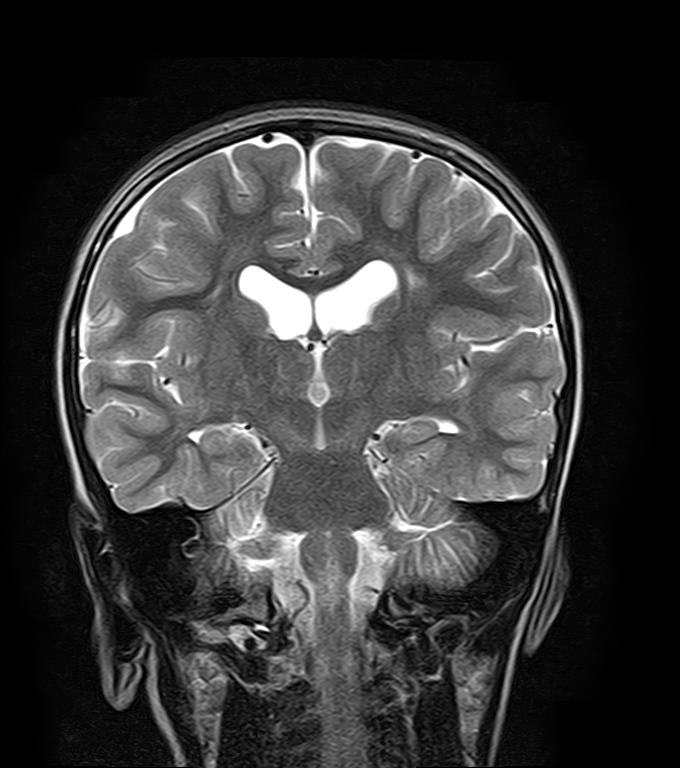 Periventricular leukomalacia | Image | Radiopaedia.org