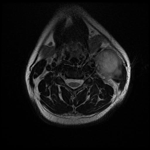 Infected Second Branchial Cleft Cyst Image 5675