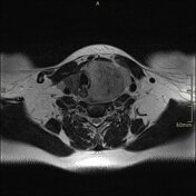 33+ Lymphoma Thyroid Cancer Ultrasound Colors