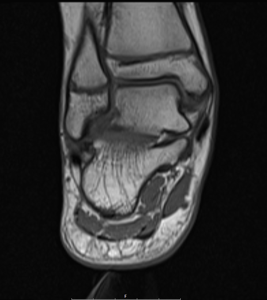 Calcaneonavicular Coalition Image