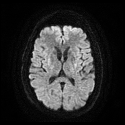 Wilson disease (CNS manifestations) | Image | Radiopaedia.org