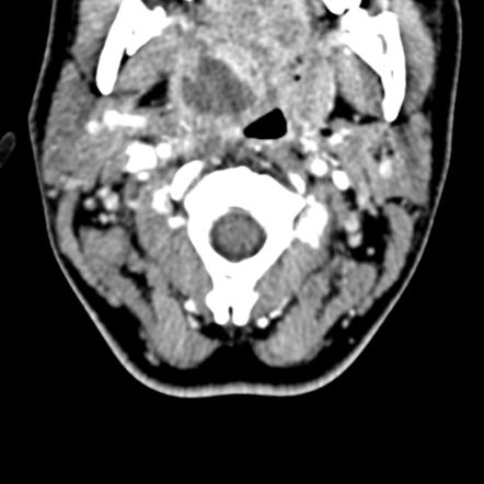 Peritonsillar abscess | Radiology Case | Radiopaedia.org