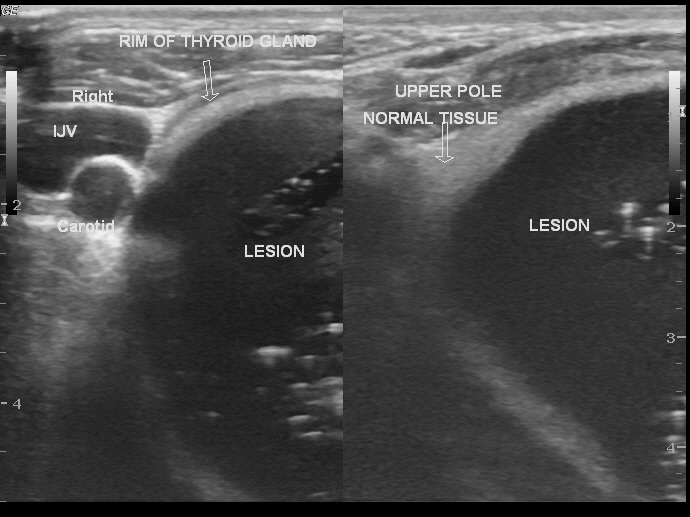 Hemorrhagic thyroid cyst | Image | Radiopaedia.org