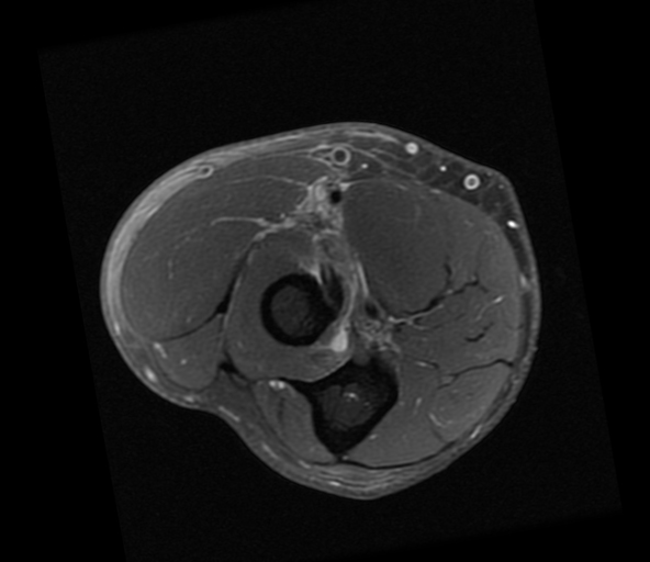 Distal Short Head Biceps Tendon Tear Mri Image