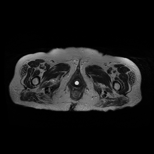 Cystocele | Image | Radiopaedia.org