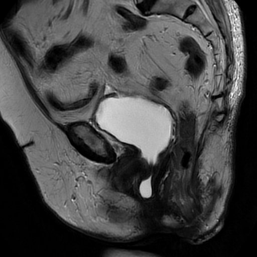 Complications After Cystocele Surgery