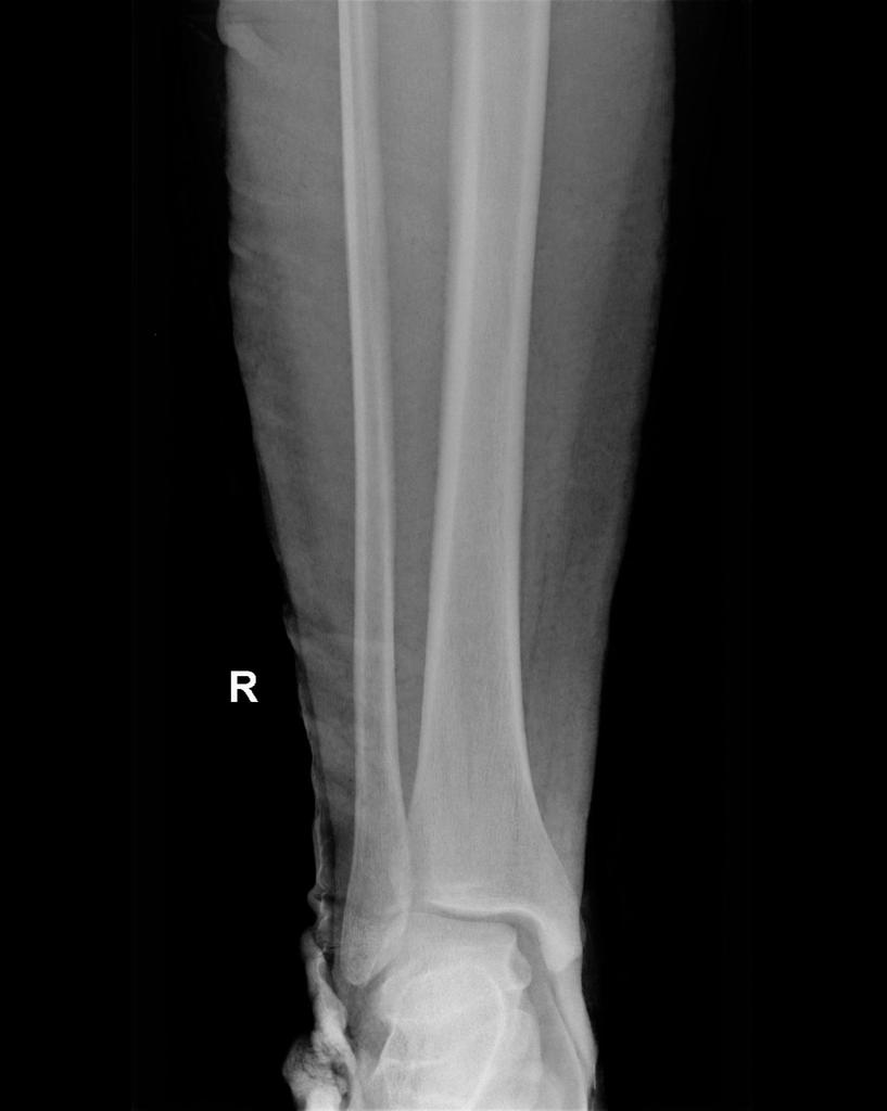 Maisonneuve fracture Image