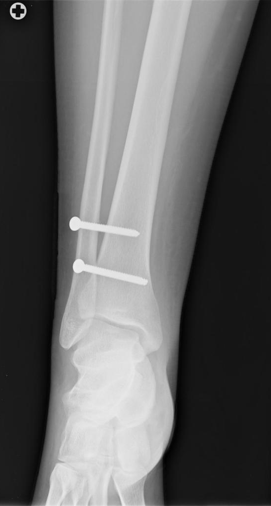 Maisonneuve fracture | Image | Radiopaedia.org