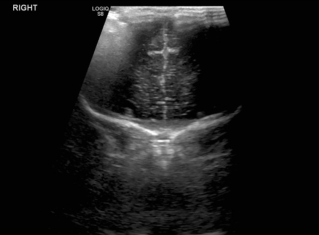 Grade Iv Germinal Matrix Hemorrhage With Periventricular Leukomalacia Image Radiopaedia Org