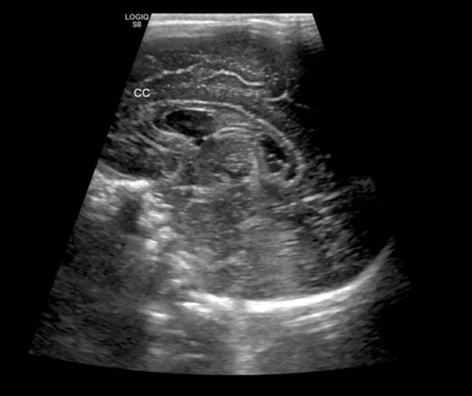 Grade IV germinal matrix hemorrhage with periventricular leukomalacia ...