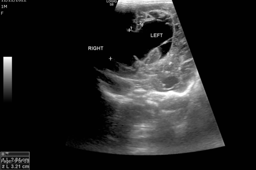 Grade Iv Germinal Matrix Hemorrhage With Periventricular Leukomalacia