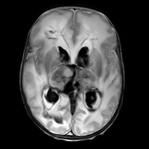 Grade Iv Germinal Matrix Hemorrhage With Periventricular Leukomalacia Image Radiopaedia Org